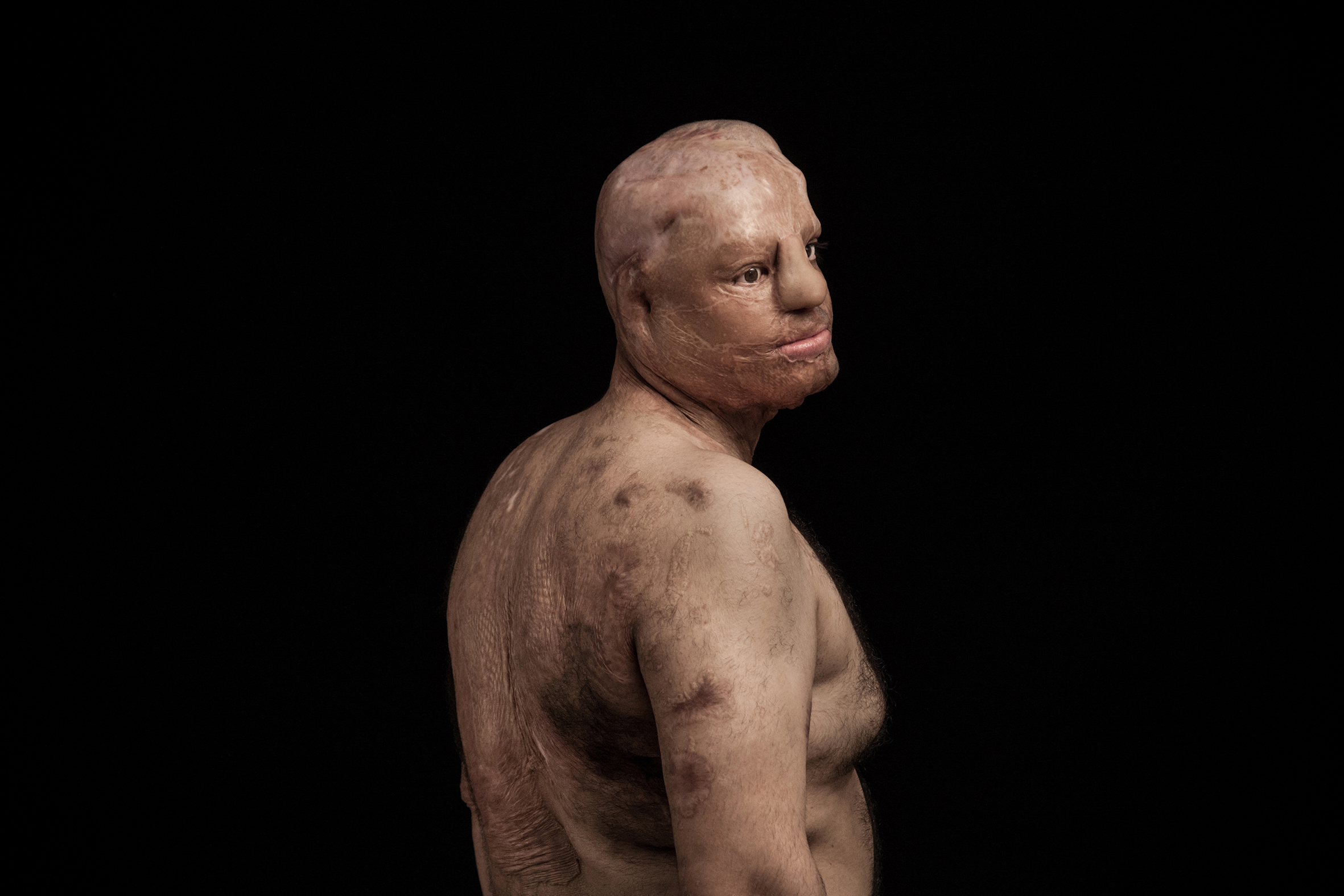 The violent act of acid throwing is primarily against women and children. These attacks are committed with the intent to disfigure, maim and destroy the social life and future of the victim. The motivation to commit this type of violence is cultural destitution, intolerance and happens in situations such as family conflicts, rejected marriage proposal, revenge and divorce requests. In addition physical and psychological damages, victims are faced with the experience of social stigma ,blame and social unpleasant tags.jpg